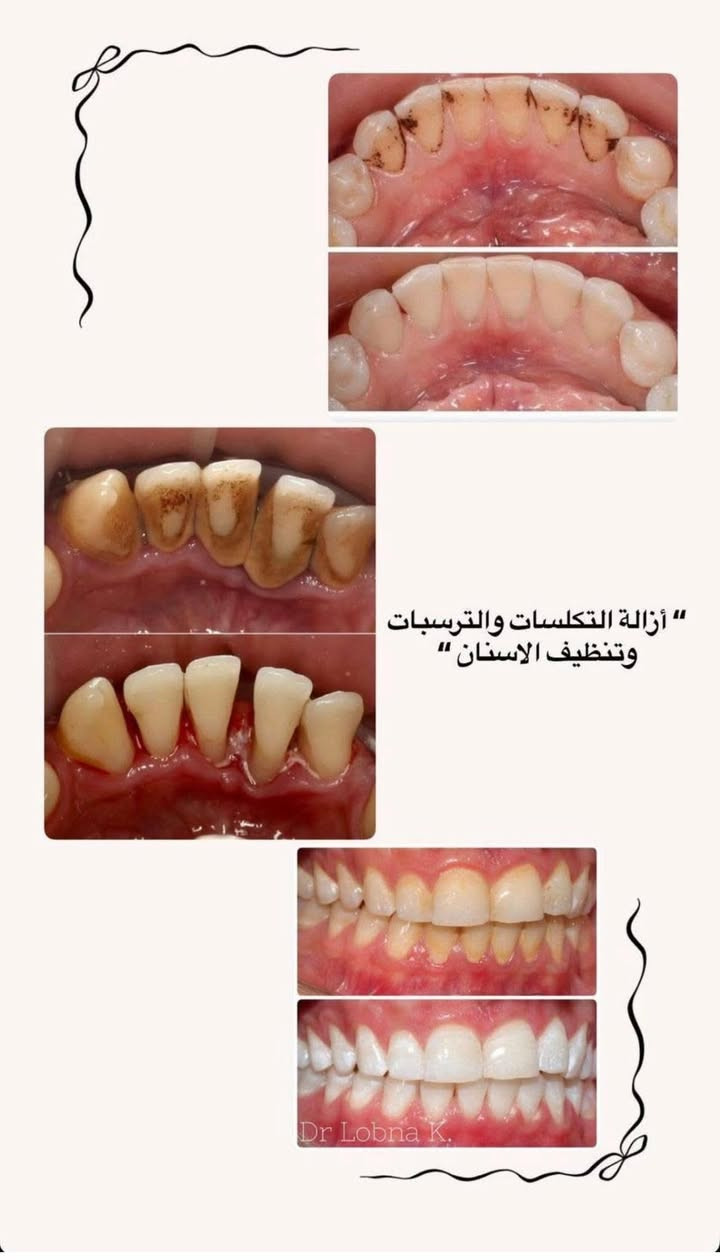 السلام عليكم الي عنده مثل هاي الحالات (تنظيف الاسنان و حشوات ضوئيه او قلع اسنان تالفه او جذور متبقيه )ويحب يعالجها مجاناً يراسلني مباشرة ع الصفحه او ع الواتساب ***********
العنوان كلية طب الاسنان جامعة بابل حي الجامعة مقابل كراج الموحد 
د.كوثر صباح

نص مكتوب في الصور:
- هاي الحالات الي نستقبلها ب عيادات الجامعة الحشوات الضوئية والتجميلية أستقبل كل حالات التسوس الموضحة بالصور
- “ قلع الأسنان التالفة وسن العقل والجذور المتبقية “
- أزالة التكلسات والترسبات وتنظيف الاسنان Dr Lobna K.