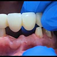 فك متحرك ثابت • استعادة الابتسامة • أقساط