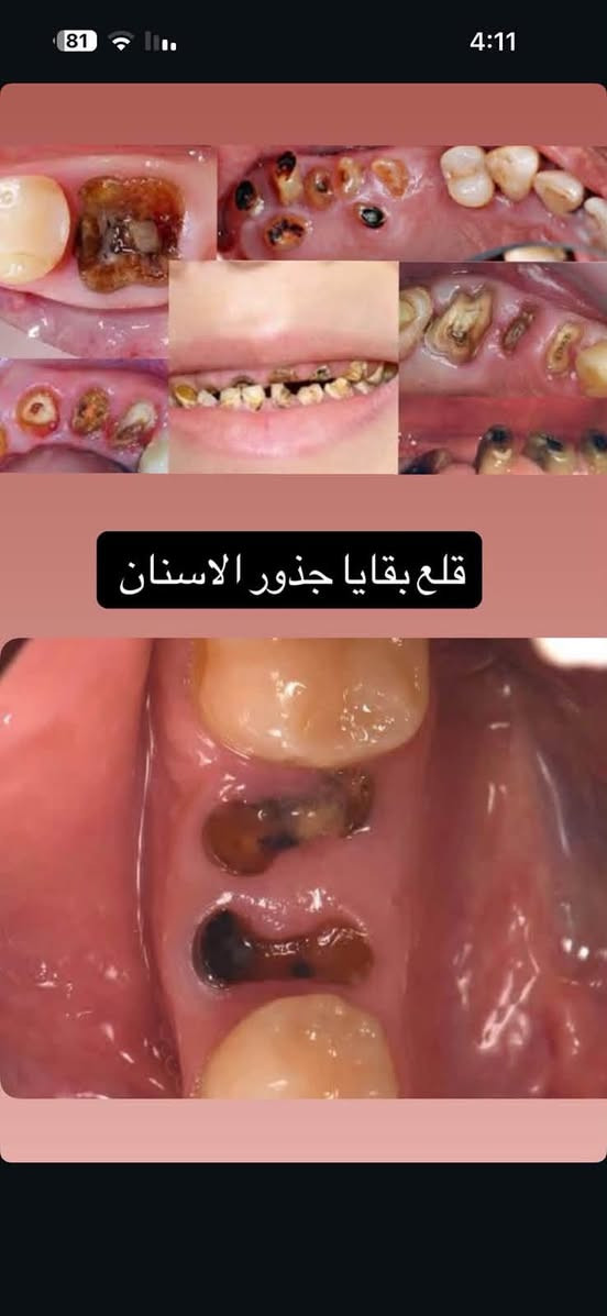 علاج مجاناً لأهالي بغداد
السلام عليكم 
علاج الاسنان في عيادات جامعة الاسراء مجاناً لجميع الحالات التالية
-تنظيف
-قلع بقايا الجذور
-قلع الاسنان
-حشوات ضوئية
-حشوات جذور
-حشوات تجميلية
-تقويم للحالات البسيطة
-طقم اسنان متحرك( تعويض الاسنان )
كل هذا مجاني وبالخدمة
للاستفسار *********** يرجى الإرسال على واتساب او على الفيس بوك

نص مكتوب في الصور:
- قلع بقايا جذور الاسنان