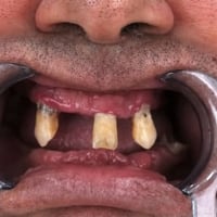 طقم اسنان • مجاني • عيادات الاسراء