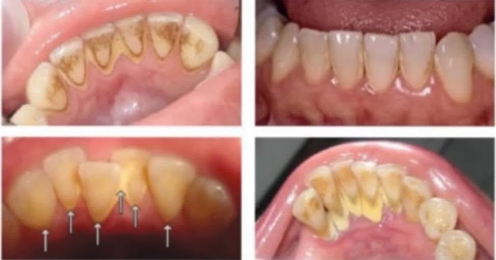 ​«ابتسامتك تستحق الاهتمام.. والعلاج مجاناً بالكامل! 🦷✨»
السلام عليكم جميعاً،
مع بدء العيادات التعليمية، أستقبلكم في العيادة التعليمية لطب وجراحة الفم والأسنان لتقديم أفضل الخدمات الطبية وبأعلى جودة وتحت إشراف كبار الأطباء والأساتذة الاختصاص.
​الخدمات المتوفرة مجاناً:
🔍 فحص وتشخيص أولي كامل للأسنان.
🪥 تنظيف الأسنان وإزالة التكلسات.
🦷 حشوات الأسنان (التجميلية والدائمة).
🦷 قلع الأسنان (حسب الحالة).
🦷 تركيب طقم أسنان (جزئي أو كامل).
💡 تعليمات العناية بصحة الفم والأسنان.
​📍 المكان: العيادة التعليمية - مجمع كليات باب المعظم (كلية أصول الدين).
📞 للحجز والاستفسار: التواصل عبر الخاص أو الرقم التالي (واتساب/اتصال): ***********
​أهلاً وسهلاً بكم دائماً! ❤️

نص مكتوب في الصور:
- ابتسامتك تستحق الاهتمام
- الدكتورة
- THE DOCTOR
- فاطمة قحطان جبر
- الخدمات المتوفرة
- فحص وتشخيص أولي للأسنان
- تنظيف الأسنان وازالة التكلسات
- تعليمات العناية بصحة الفم والأسنان
- حشوات الأسنان
- قلع الأسنان حسب الحالة
- تركيب طقم أسنـان (جزئي أو كامل حسب الحالة)
- العلاج مجاناً
- جميع الإجراءات تحت إشراف دكاترة اختصاص
- للواصل
- ***********
- العيادة التعليمية (مجمع كليات باب معظم) كلية أصول العلم