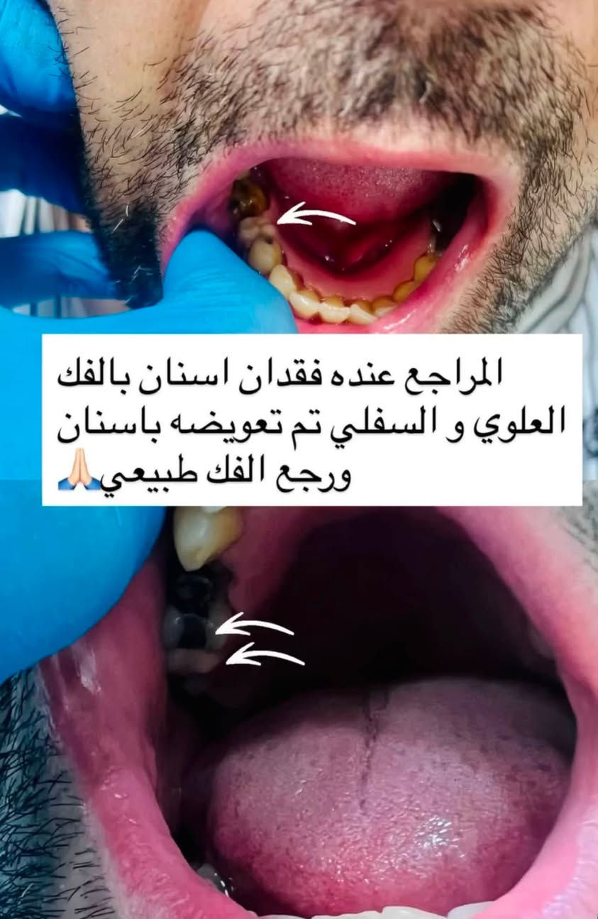 مجاناً….مجاناً…مجاناً
السلام عليكم تم فتح باب العيادات الهاي السنه و الحجز محدود نوفر الكم 
🦷تنضيف اسنان باحدث الادوات
🦷حشوات جذور وتجميليه بتقنيات متطوره
🦷قلع الاسنان التالفه
🦷تعويض طقم اسنان مفقوده
🦷تقويم اسنان حسب الحاله يحدد بعد الفحص
👶عيادات اطفال خاصه للعينايه و الوقايه من التسوس
العنوان كراده ساحه الاندلس عيادات جامعه الاسراء 
للتواصل ***********
