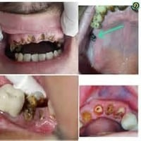 جذور متبقية • أسنان متحركة • علاج مجاني