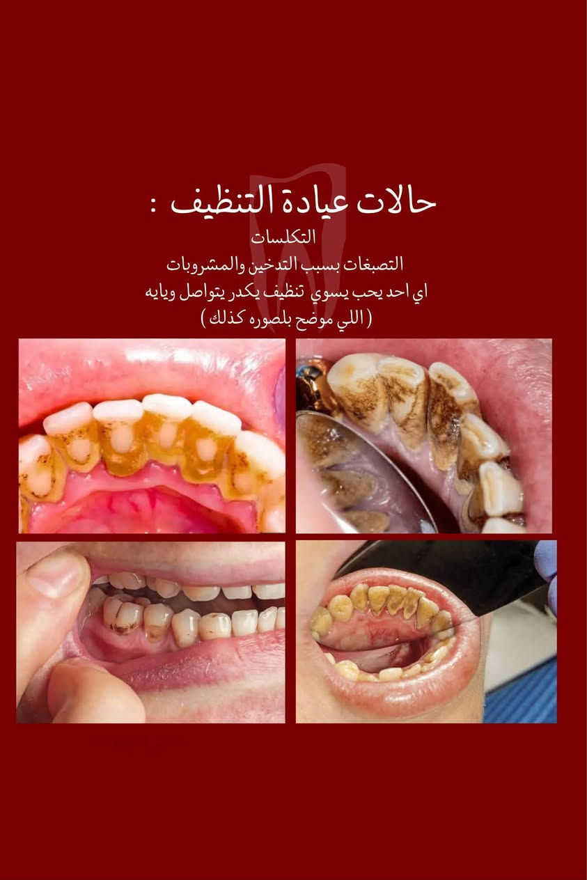 السلام عليكم
نعلن عن توفر خدمات العلاج المجاني للأسنان بشكل كامل 
تحت اشراف اطباء مختصيين 
بحالة عدكم 
(قلع ، تسوسات ، تعويض اسنان بطقم متحرك، تنظيف اسنان) والحالات الي موجوده بلصور وتحبون تعالجوها   بشكل مجاني تكدرون تتواصلون ويايه ونرتب موعد يناسبكم على الرقم  ***********  
موقع العيادات : الدوره _ شارع المصافي_ كلية دجله الجامعه

نص مكتوب في الصور:
- الدكتورة رغد عامر طالبة طب اسنان تحت التدريب من خدماتنا علاج تسوس الاسنان باستخدام الحشوات الضوئيه تعويضات صناعية للأسنان المفقوده تنظيف الاسنان وتلميع الاسنان من التكلسات قلع الاسنان وبقايا الجذورالتالفه احجز موعدك الأن الدورة_ شارع المصافي_ جامعة دجله *********** @msqai علماً ان العلاج مجاني و تحت اشراف اطباء مختصییبن
- حالات عيادة الجراحة : بقايا جذور الاسنان التالفه الاسنان المتحركه الاسنان التالفه
- حالات عيادة الحشوات :
- • تسوس على سطح السن
- • بين الاسنان الخلفيه
- • بين الاسنان الامامية
- • حافات الاسنان المكسوره
- • تسوس قريب اللته
- • ازالة الحشوات القديمة
- حالات عيادة التنظيف : التكلسات التصبغات بسبب التدخين والمشروبات اي احد يحب يسوي تنظيف يكدر يتواصل ويايه ( اللي موضح بلصوره كذلك )
- حالات عيادة التعويض : تعويض الاسنان المفقوده بطقم جزئي متحرك مثل الحالات الموضحه بلصور