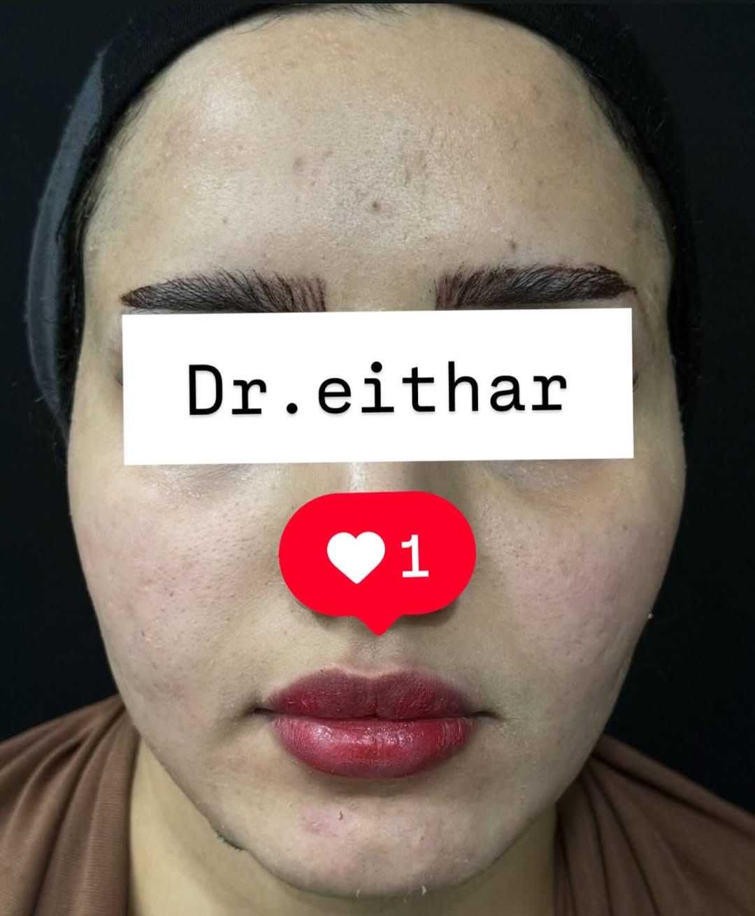 كونتور الوجه بالفلر  (لفتنك وجنات  واصداغ وتدوير الفك والذقن ونظاره وشفة تعديل ع حقن سابق للشفة) 🔥🔥
لاحضو الفرق بالذقن ومنطقه الفك   شكد تغير الشكل🔥
عروووض للكادر التدريسي والخريجات والموظفات والعروسات  ثبتتهه الكم بالستوري بالهايلايت وببوست اعلى الصفحة ✨✨

د.ايثار سامي عبد الامير
واسط الكوت الهوره مجمع القبطان طابق اول 

الحجز***********

نص مكتوب في الصور:
- Dr.eithar 1