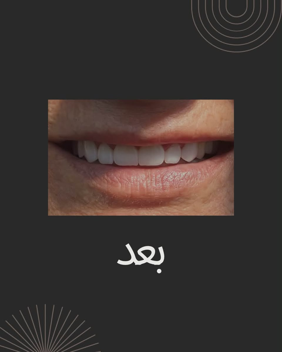 ✨ ابتسامة جديدة… وثقة أجمل 🤍

يسعدنا اليوم نشارككم نتيجة إحدى حالاتنا، حيث قمنا بإعادة تصميم الابتسامة لتكون طبيعية، متناسقة، وتعكس جمال الملامح

الدكتورة الفنانة ‪@dr.farahibrahim‬ 

📍عيادة الفهد لطب وتجميل الأسنان
 (بغداد-العبيدي-شارع ٢٠ - قرب مدرسة سما بلادي الاهلية - الطابق الاول )
📞 ***********
📞 ***********
.
.
.
.
.
.
.
#عيادة_الفهد #ابتسامة٠هوليود #حشوة_جذر #عيادةأسنان #ابتسامه #اكسبلور #المشتل # #فولو #لايكات #فايرل #اسنان
