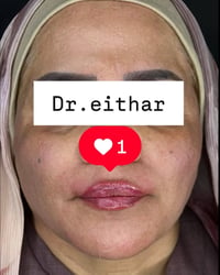 كونتور بالفلر • تدوير الفك والذقن • واسط الكوت