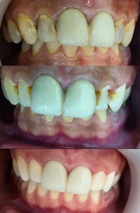 حشوات تجميلية • عيادة لانا • عفك