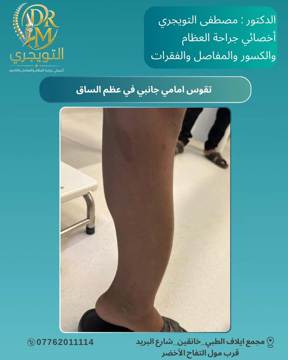 🧬✨ مو كل علامة على الجلد تكون بسيطة… 

الورم الليفي العصبي من النوع الأول (Neurofibromatosis ) هو مرض وراثي يمكن أن يؤثر بشكل رئيسي على الجلد الأعصاب العظام والعينين 🧠🦴👁️ 

التشخيص المبكر والمتابعة الطبية يساعدان على اكتشاف التغيرات ومتابعتها بشكل أفضل ❤️‍🩹 

🔎 الوعي بالمرض… أول خطوة نحو رعاية أفضل.
الدكتور : مصطفى التويجري
أخصائي جراحة العظام والكسور والمفاصل 👨‍⚕️ 

📞 للحجز والاستفسار تواصل معنا الآن
📞 *********** 

📍 العنوان: مجمع إيلاف الطبي _ ديالى خانقين _ شارع البريد _ قرب مول التفاح الأخضر 

✨ رعايتك تبدأ بخطوة… وخطوتك الأولى هي الاستشارة الصحيحة. 

#الدكتور_مصطفى_التويجري
#مجمع_إيلاف_الطبي #خانقين
#الورم_الليفي_العصبي 
#Neurofibromatosis
