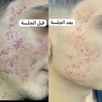 جلسة سكر • قبل وبعد • الأمين الثانية