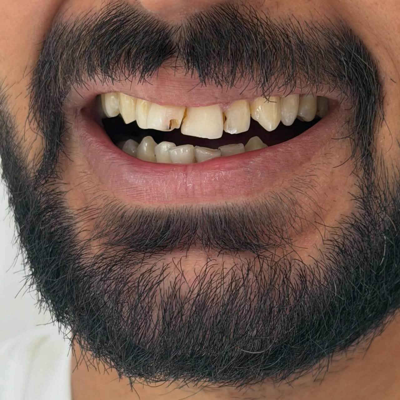 جمال أسنانك.. سر جاذبيتك!

استرجع لمعان وقوة أسنانك مع خدمات التغليف والتركيبات الحديثة في مركز الديوانية التخصصي. ابتسامتك هوليودية بامتياز وبأيدي أمهر الأطباء
متواجدين طيلة ايام الاسبوع
نستقبلكم بكل حُب
العنوان : الديوانية/ تحت الجسر المعلق / بناية فندق الديوانية سابقًا / مقابل
المحافظة
للحجز والاستفسار
***********
***********
