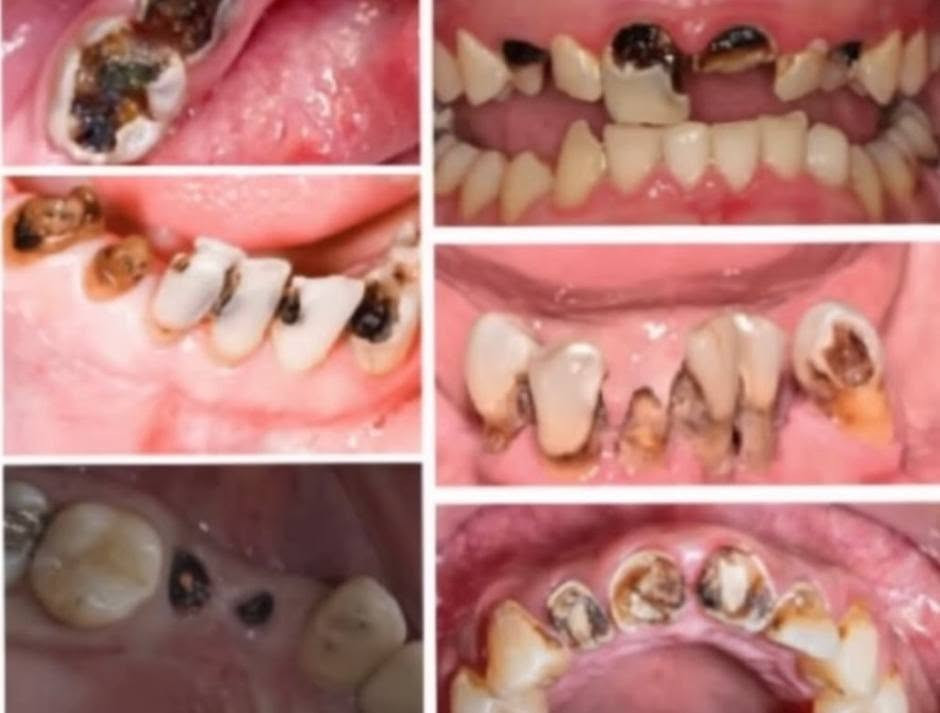 ​«ابتسامتك تستحق الاهتمام.. والعلاج مجاناً بالكامل! 🦷✨»
السلام عليكم جميعاً،
مع بدء العيادات التعليمية، أستقبلكم في العيادة التعليمية لطب وجراحة الفم والأسنان لتقديم أفضل الخدمات الطبية وبأعلى جودة وتحت إشراف كبار الأطباء والأساتذة الاختصاص.
​الخدمات المتوفرة مجاناً:
🔍 فحص وتشخيص أولي كامل للأسنان.
🪥 تنظيف الأسنان وإزالة التكلسات.
🦷 حشوات الأسنان (التجميلية والدائمة).
🦷 قلع الأسنان (حسب الحالة).
🦷 تركيب طقم أسنان (جزئي أو كامل).
💡 تعليمات العناية بصحة الفم والأسنان.
​📍 المكان: العيادة التعليمية - مجمع كليات باب المعظم (كلية أصول الدين).
📞 للحجز والاستفسار: التواصل عبر الخاص أو الرقم التالي (واتساب/اتصال): ***********
​أهلاً وسهلاً بكم دائماً! ❤️

نص مكتوب في الصور:
- ابتسامتك تستحق الاهتمام
- الدكتورة
- THE DOCTOR
- فاطمة قحطان جبر
- الخدمات المتوفرة
- فحص وتشخيص أولي للأسنان
- تنظيف الأسنان وازالة التكلسات
- تعليمات العناية بصحة الفم والأسنان
- حشوات الأسنان
- قلع الأسنان حسب الحالة
- تركيب طقم أسنـان (جزئي أو كامل حسب الحالة)
- العلاج مجاناً
- جميع الإجراءات تحت إشراف دكاترة اختصاص
- للواصل
- ***********
- العيادة التعليمية (مجمع كليات باب معظم) كلية أصول العلم