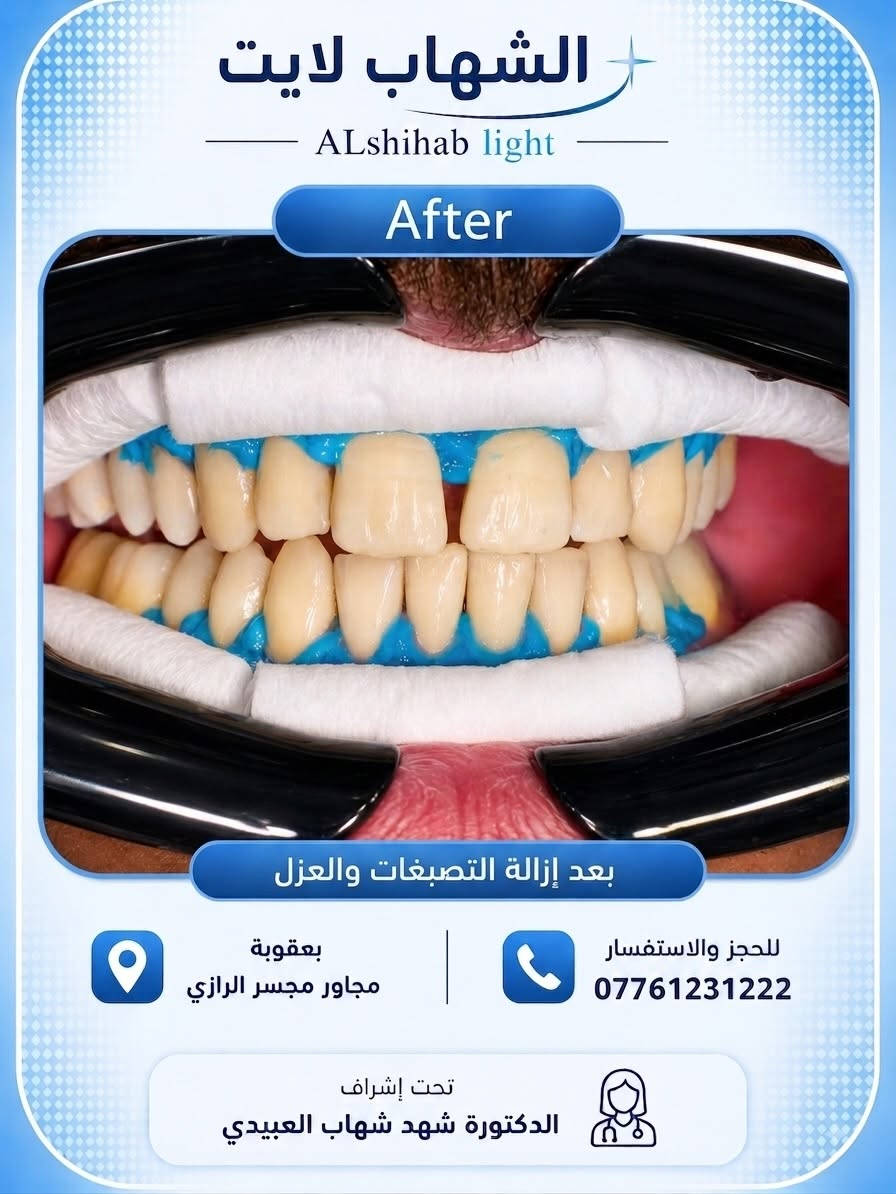 � حالة اليوم | تنظيف الأسنان وإزالة التصبغات ✨

مراجعنا اليوم كان يعاني من تراكم التصبغات والبقع على الأسنان، وتم إجراء جلسة تنظيف احترافية وإزالة التصبغات للحصول على أسنان أنظف ومظهر أكثر صحة، مع الحفاظ على اللون الطبيعي للأسنان بدون مبالغة 🤍

✨ ملاحظة: لمن يرغب بدرجة أفتح من لون الأسنان الطبيعي، تتوفر لدينا أيضاً خدمة تبييض الأسنان بالليزر بعد تقييم الحالة وتحديد الخيار المناسب.

لأن النتيجة الحلوة مو شرط تكون مبالغ بيها…
الجمال الحقيقي بالنتيجة الطبيعية والمصداقية. 🦷🤍

📍 بعقوبة – مجاور مجسر الرازي
📞 للحجز والاستفسار: ***********

الشهاب لايت | ALshihab light
تحت إشراف الدكتورة شهد شهاب العبيدي

#تنظيف_الأسنان #إزالة_التصبغات #تبييض_الأسنان #تبييض_بالليزر #تصبغات_الأسنان صحة_الأسنان ابتسامة_صحية العناية_بالأسنان طب_الأسنان عيادة_أسنان طبيب_أسنان تنظيف_اسنان اسنان_بعقوبة بعقوبة ديالى العراق DentalCleaning TeethCleaning LaserTeethWhitening DentalClinic HealthySmile OralHealt
