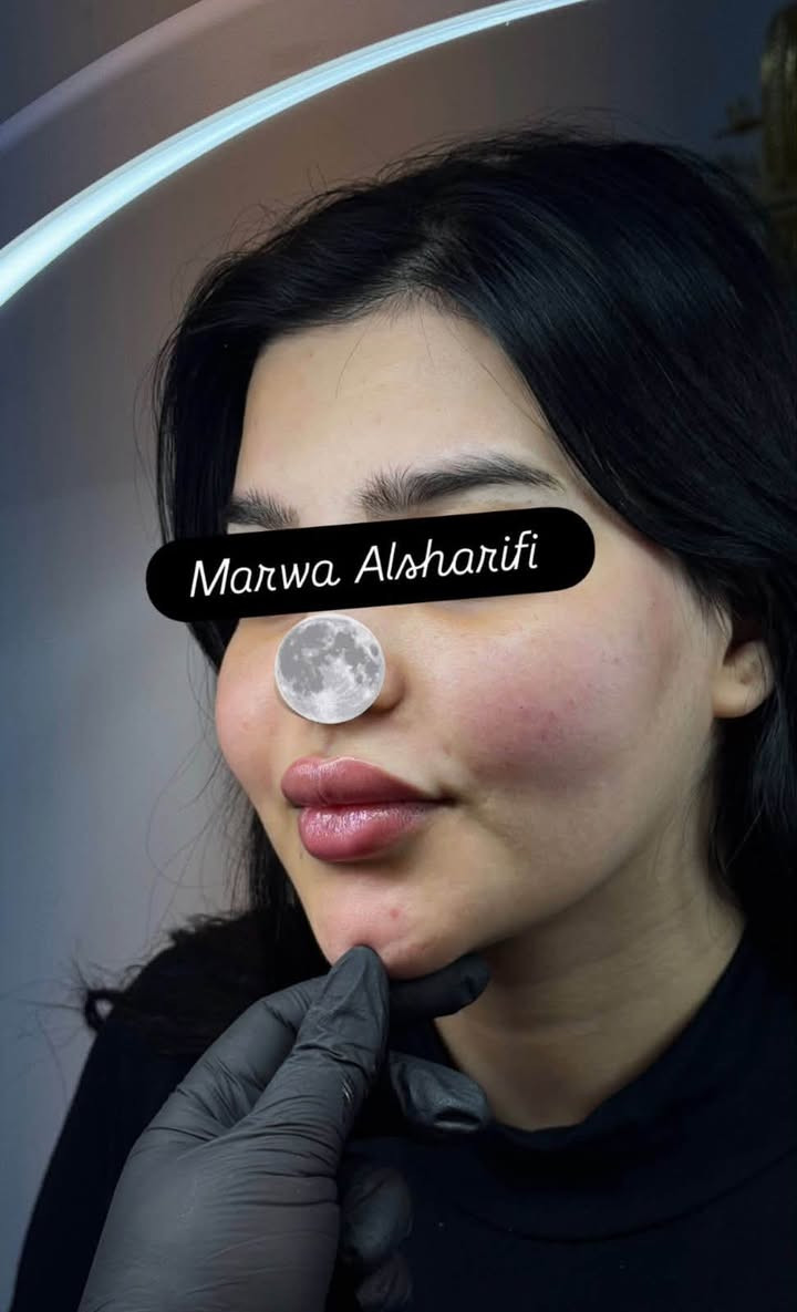 تغيير شامل بالفلر رسمة وجه القمر من ايد خبيرة التجميل الغير جراحي Marwa Alsharifiمروة الشريفي 
للحجز على الرقم ***********
او مراسلة الصفحة
