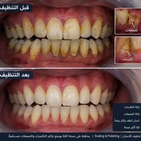 يوجد تنظيف الأسنان وحشوات وقلع اسنان التالفه للحجز 07817003680  الموقع...