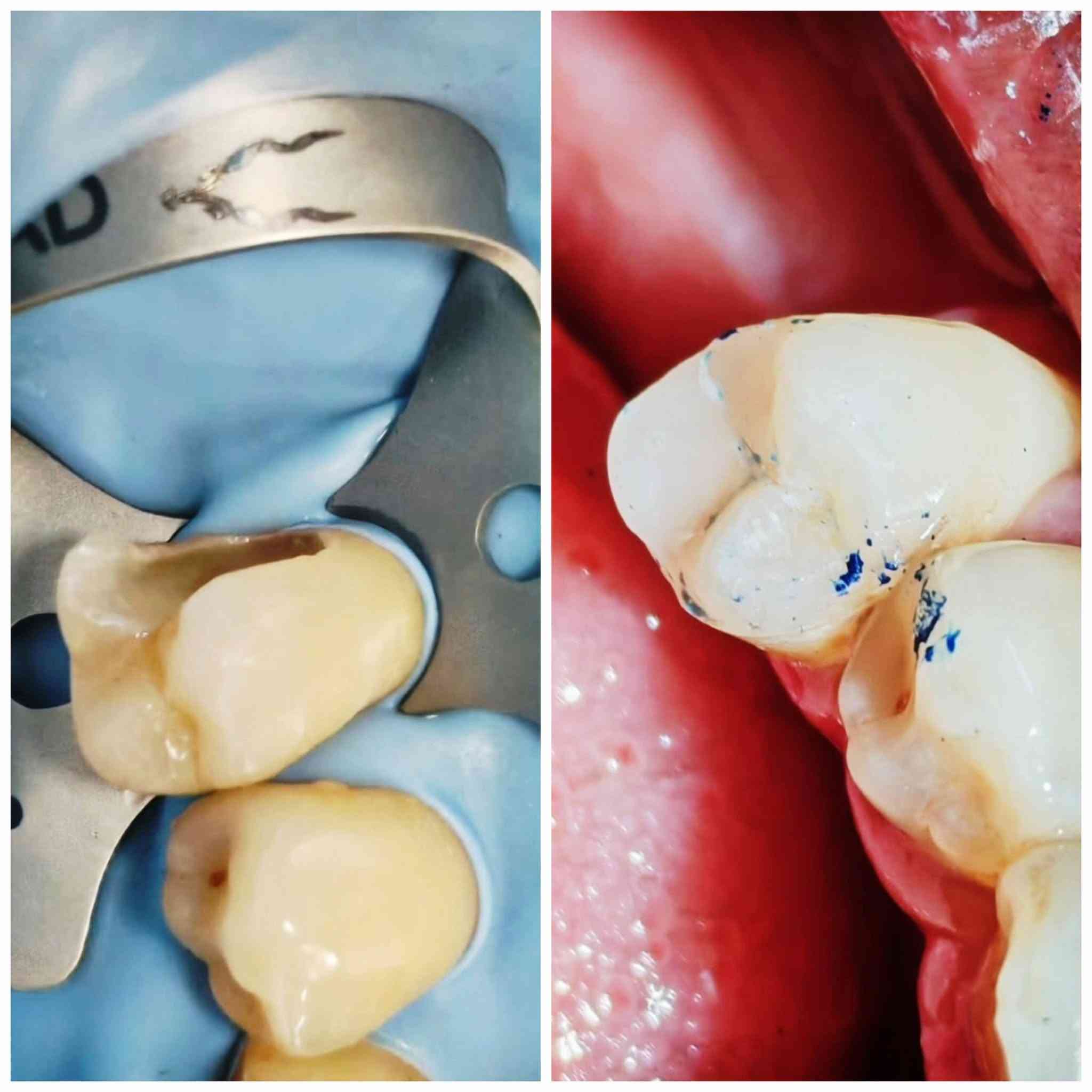 🦷 تحتاج علاج أسنان؟ نوفر لك العلاج داخل العيادة الجامعية

تتوفر حاليًا إمكانية استقبال المرضى لعلاج عدد من حالات الأسنان، بإشراف أطباء وأساتذة الاختصاص.

🔹 تنظيف وتبيض الأسنان
🔹 حشوات الأسنان الخلفية لكافة انواع تسوس 
🔹 حشوات تجميلية لعلاج كسر او تسوس الاسنان الامامية. 
🔹 علاج أسنان الأطفال
🔹فحص و علاج امراض اللثة والفم
🔹 خلع الأسنان عند الحاجة
🔹 تخم الأسنان المتحرك اذا كنت فاقد جميع الاسنان . 
🔹 حالات أخرى بعد الفحص والتقييم

📍 المكان: المستشفى التعليمي – كلية طب الأسنان جامعة بلاد الرافدين - بعقوبة -قرب تقاطع القدس. 

💰 العلاج: مجاني فقط سعر الباص. 

إذا كنت تحتاج علاجًا أو تعرف شخصًا يحتاجه، ضمن الصور المرفقة راسلنا على الخاص وأرسل:
📸 صورة الأسنان إن أمكن
📍 المنطقة
📞 رقم للتواصل

الأولوية للحالات المناسبة للإجراءات المتوفرة حاليًا.

🦷 صحتك تبدأ بخطوة بسيطة… احجز موعدك للفحص.

نص مكتوب في الصور:
- كلية طب الاسنان جامعة بلاد الرافدين رعاية متكاملة لصحة الفم والاسنان خدماتنا حشوات تجميلية وعلاج التسوس تنضيف و تلميع الأسنان قلع الاسنان علاج أسنان الأطفال صناعة وتركيب اطقم أسنان للحجز *********** ديالي,بعقوبة,قرب تقاطع القدس المستشفى التعليمي كلية طب الأسنان لجامعة بلاد الرافدين