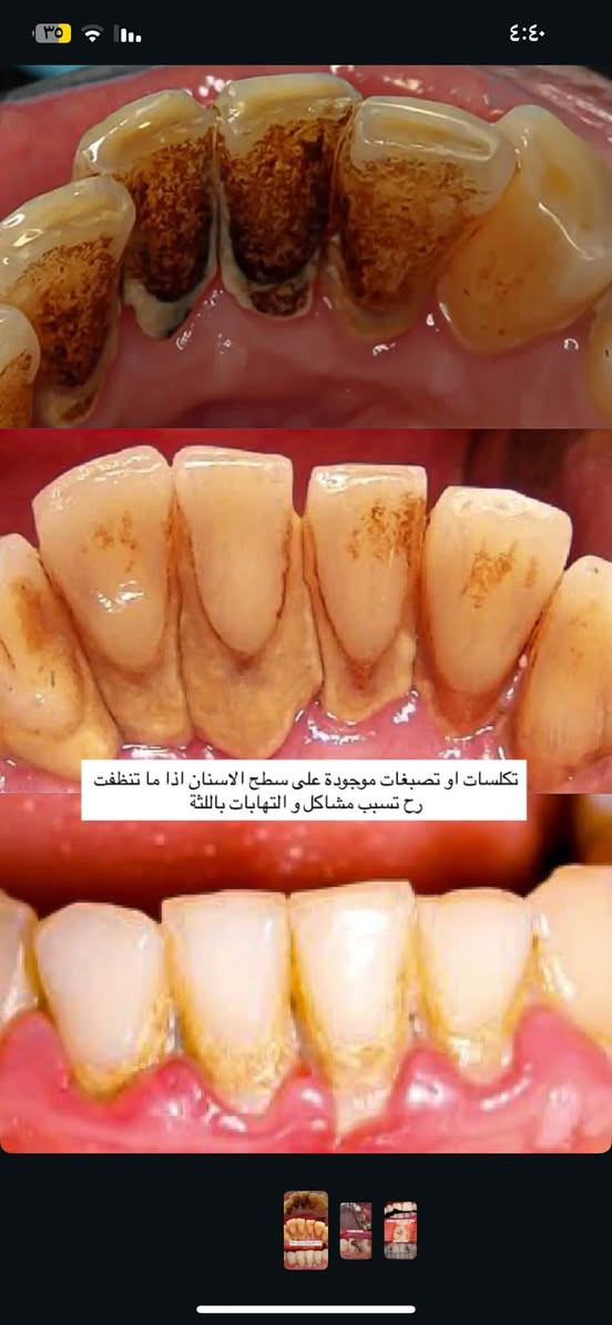 علاج مجاني • تنظيف وإزالة الجير • حشوات تجميلية