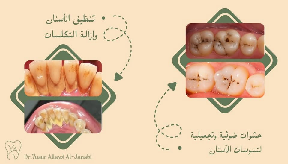 أي احد يحتاج علاج أسنان (حشوة -قلع-تعويض أسنان-تنظيف) يتواصل ويايه
وتشرفونا بحضوركم 🤍

- والعلاج مجاني بالكامل -

الموقع: الاعظمية - مجاور المقبرة الملكية 
العيادات التعليمية لكلية طب الأسنان -الجامعة العراقية

للإستفسار - التواصل على حساب الإنستغرام
أو معرف التليغرام ♥️
حساب الإنستغرام : dr.y_aljanabi
معرف التليغرام : YusurA_58
او التواصل على الواتساب عبر الرقم 
***********

الصور أمثلة على الحالات الي نشتغلها:

نص مكتوب في الصور:
- طبيبة الأسنان د. يُسر علاوي الجنابي - إبتسامتك ، أولويتنا -
- د. يُسر علاوي الجنابي
- فحص وتشخيص الأسنان
- تنظيف الأسنان وإزالة التّكلسات
- حشوات ضوئيّة وتجميليّة
- تعويض الأسنان المفقودة بطقم جزئي
- قلع الأسنان التالفة وبقايا الجذور
- العلاج مجاني وبإشراف أطباء مختصين
- YA
- YusurA_58
- Dr.y_aljanabi
- العيادات التعليمية لطب الأسنان - الجامعة العراقية
- الاعظمية - قرب المقبرة الملكية
- تنظيف الأسنان وإزالة التكلسات
- حشوات ضوئية وتجميلية لتسوسات الأسنان
- Dr. Yusur Allawi Al-Janabi
- تعويض الأسنان المفقودة بطقم جزئي متحرك قلع الأسنان التالفة وبقايا الجذور Dr.Yusur Allawi Al-Janabi