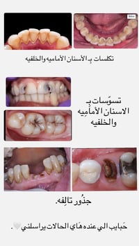 تكلسات اسنان • قلع اسنان • حشوات
