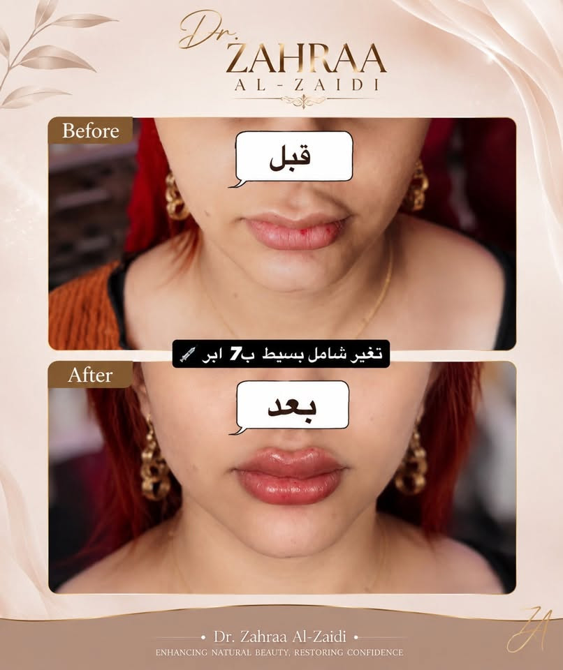 السلام عليكم 🌷
وياكم دكتورة زهراء 🤍

✨ جايتكم بعروض شهرية مميزة ✨

💉 فلر
💉 بوتكس
💉 إبر النضارة
✨ وتغيير شامل

العروض لمدة أسبوعين فقط ⏳
وبأسعار مناسبة ومميزة 🤍

📲 للحجز والاستفسار واتساب:
***********

📸 الإنستغرام:
dr_zeo.0

✨ لا تفوتكم عروض هذا الشهر ✨
