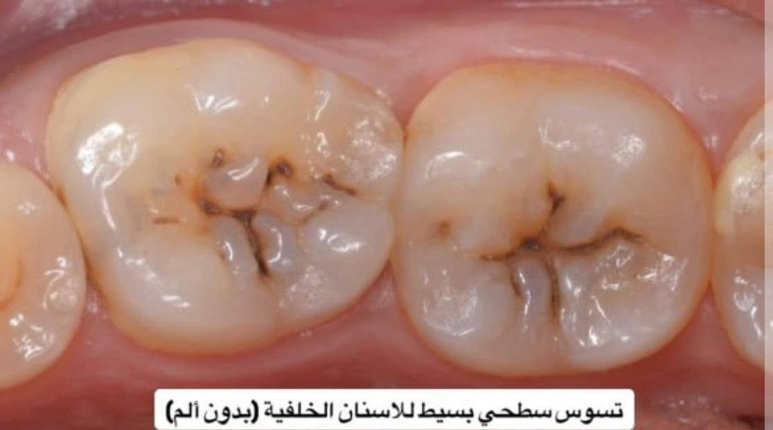 علاج مجاني • تنظيف اسنان • تسوس جانبي