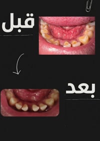 علاج مجاني • جامعة بابل • قلع وحشوة