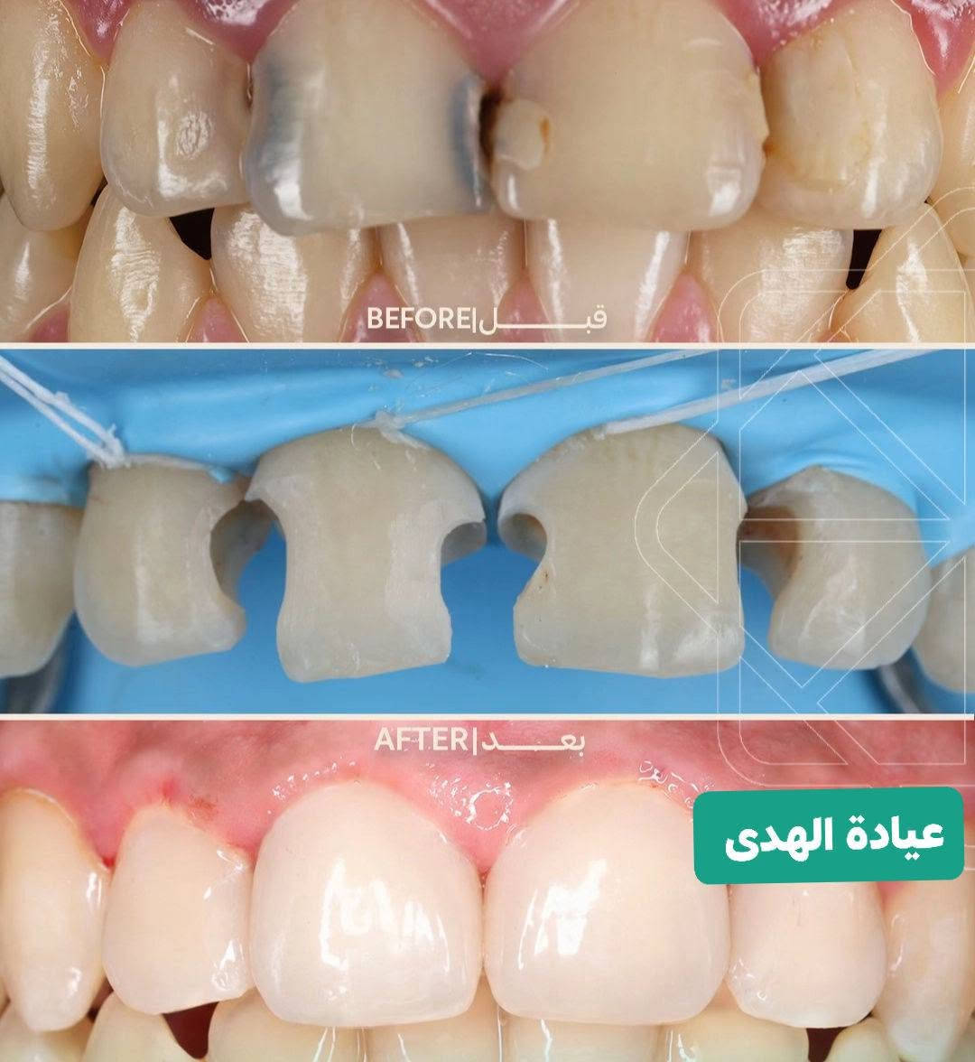 عيادة الهدى لطب الأسنان والتجميل

تقاطع الجدوع مجاور عالم الحليب

***********

اهلا وسهلا بزبائنا الاعزاء

متواجدين يوميا من ٤ عصرا إلى ٩ مساء

نص مكتوب في الصور:
- عيادة الهدى
- BEFORE | قبل AFTER | بعد عيادة الهدى
- BEFORE | قبل
- AFTER | بعد