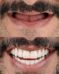 أسنان مجانية • طقم أسنان • كربلاء