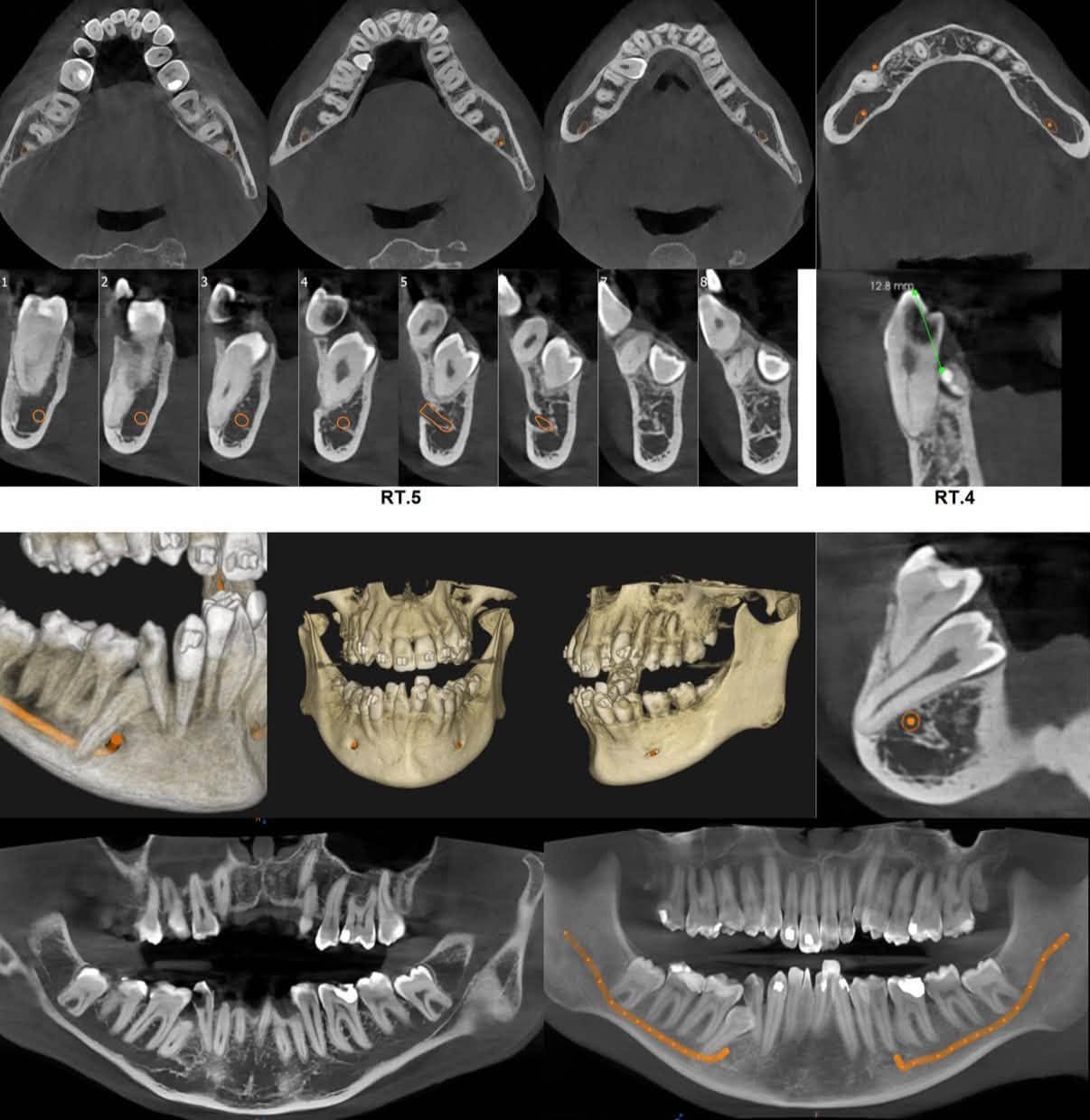 جهاز CBCT Caresteam 8200
السلام عليكم جهاز CBCT شركة كيرستريم من الوكيل حصراً
للبيع مستعمل 9 اشهر فقط جداً نضيف مخزون في مخزن الوكيل
احدث سوفت وير فيلد يصل الى 16x10
المكان بغداد - للتواصل والاستفسار ***********

نص مكتوب في الصور:
- 1 2 3 4 5 6 7 8 12.8 mm RT.5 RT.4
- CS 3D Imaging v3.10.47 BETA Analysis 9/15/2021 MPR Curve Bilateral Review Adjustments Analysis 59 85 17 Tools AI 34.4 mm zoom: 0.70 R L A P FDK 0 um zoom: 0.81 1x3 87.1 mm H B FDK 150 um AVG 150 um 87.3 mm zoom: 1.60 H L B FDK FDK 87.5 mm H L B L Objects Arch/temporal bone Maxillaire Mandibule Airway 13.9 cm³ Gallery