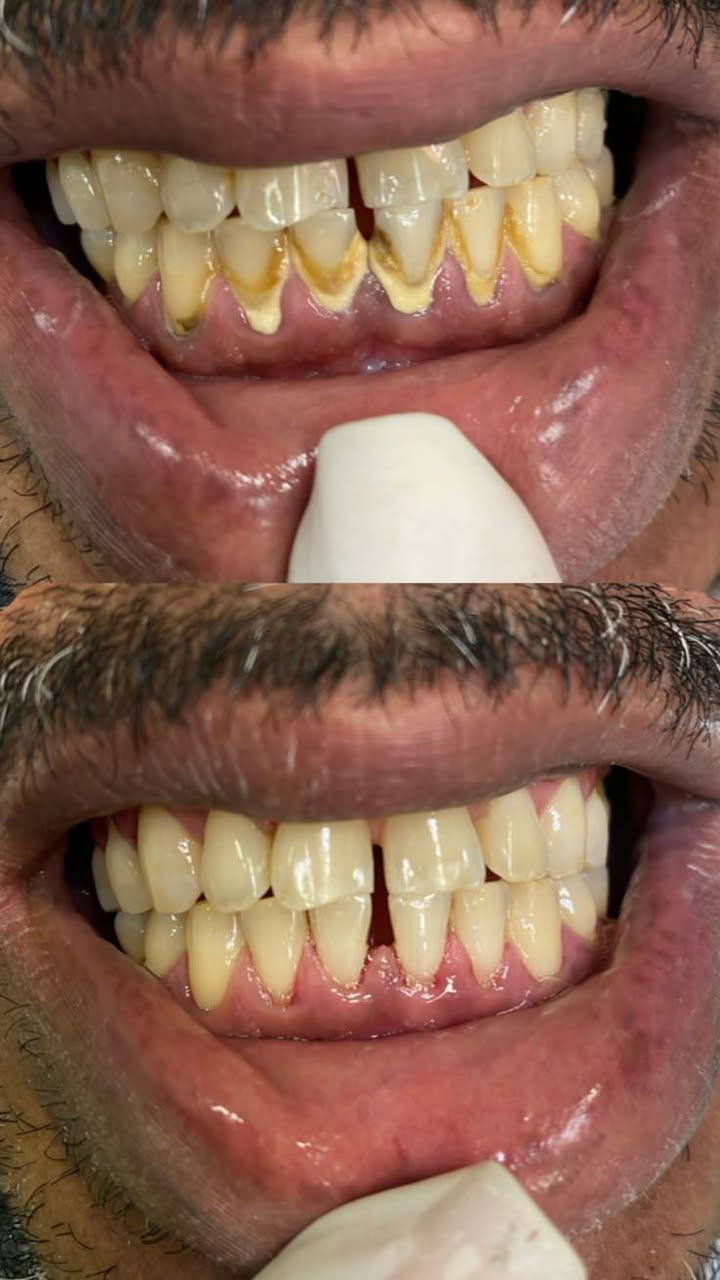 كلما چنت أريد أضحك.. چنت أغطي حلگي بـإيدي.."مجرد تنضيف يغير  نفسيتك للأفضل لا تهمل اسنانك 

لأن راحتكم تهمنا.. الابتسامة صارت بالتقسيط!
​عقدة المادة ما لازم تمنعك من العناية بصحتك وجمال ضحكتك، وتقديراً لجهودكم وتضحياتكم، فتحنا باب العلاج بنظام النقد (الكاش) أو الأقساط الشهرية المريحة:
​لأبطالنا العسكريين 👮‍♂️
​لأهلنا المتقاعدين 🧓
​لكافة الموظفين الموطنة رواتبهم على (مصرف الرافدين) 🏦

​💡 قصتك القادمة تبدأ بقرار.. لا تخلي التكلفة تأجل ضحكتك، 
​📞 احجز موعدك الآن واصنع قصتك الخاصة:
​
​رقم الواتساب / الهاتف: [ *********** ]
​أو ارسل لنا رسالة مباشرة على بريد الصفحة 📩
​#قصص_النجاح #طب_أسنان #ابتسامة_جديدة #مصرف_الرافدين #تسهيلات_دفع #أقساط #العراق
