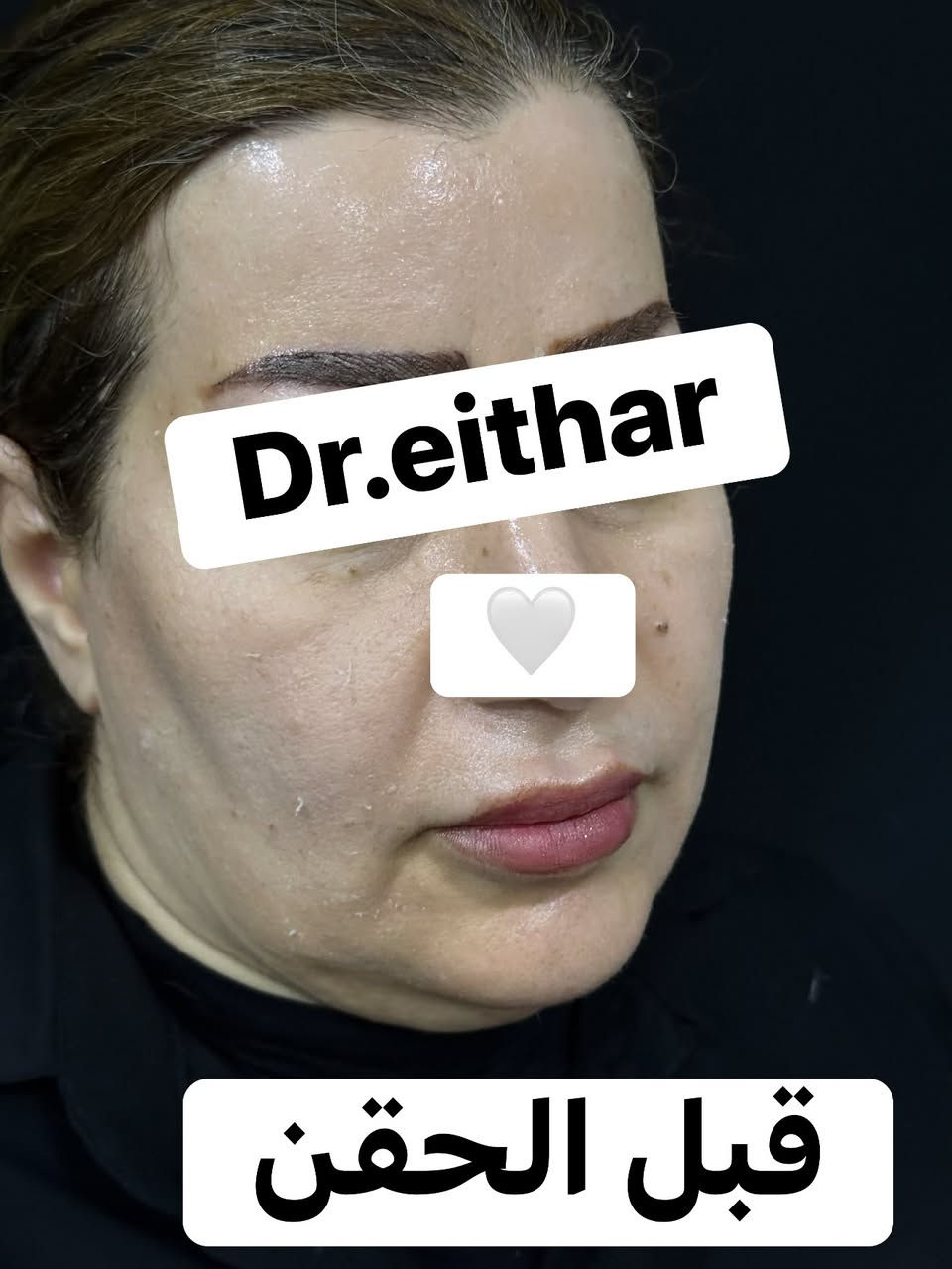 استداره الوجه كامله (لفتنك وجنات واصداغ وتدوير الفك والذقن ونظاره) 🔥🔥

عروووض فرحة الزهره ثبتتهه الكم بالستوري بالهايلايت وببوست اعلى الصفحة ✨✨

د.ايثار سامي عبد الامير
واسط الكوت الهوره مجمع القبطان طابق اول 

الحجز***********
