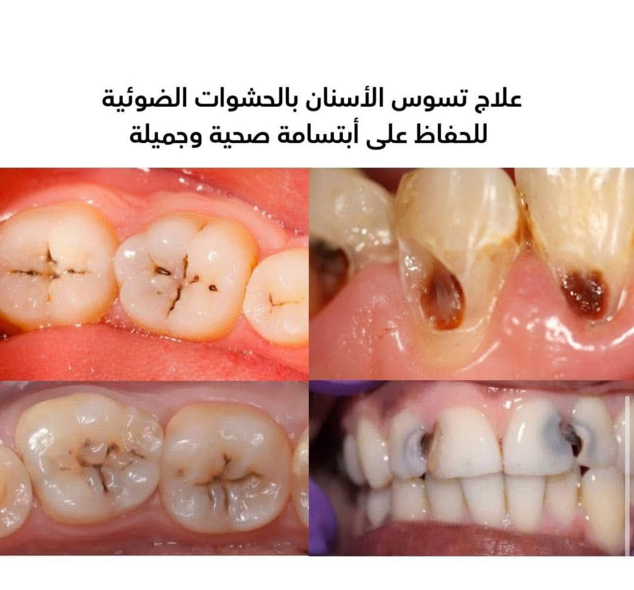 مرحبا متوفر معالجة لِـ :
_ قلع الاسنان والجذور التالفة
_ ازالة التسوسات وتعويضها بحشوات ضوئية .
  _ تعويض الاسنان المفقودة بطقم كامل متحرك .
_ تنظيف الاسنان وازالة التكلسات .
_ حشوات جذرية للاسنان الامامية 
في عيادات جامعة المشرق
 
 العلاج مجاني

العنوان _ بغداد _ شارع المطار _ جامعة
المشرق
تواصل واتساب : ***********

نص مكتوب في الصور:
- تعويض الأسنان المفقودة بطقم جزئي متحرك
- تنظيف الأسنان وأزالة التكلسات
- علاج تسوس الأسنان بالحشوات الضوئية للحفاظ على أبتسامة صحية وجميلة
- قلع الأسنان والجذور التالفة