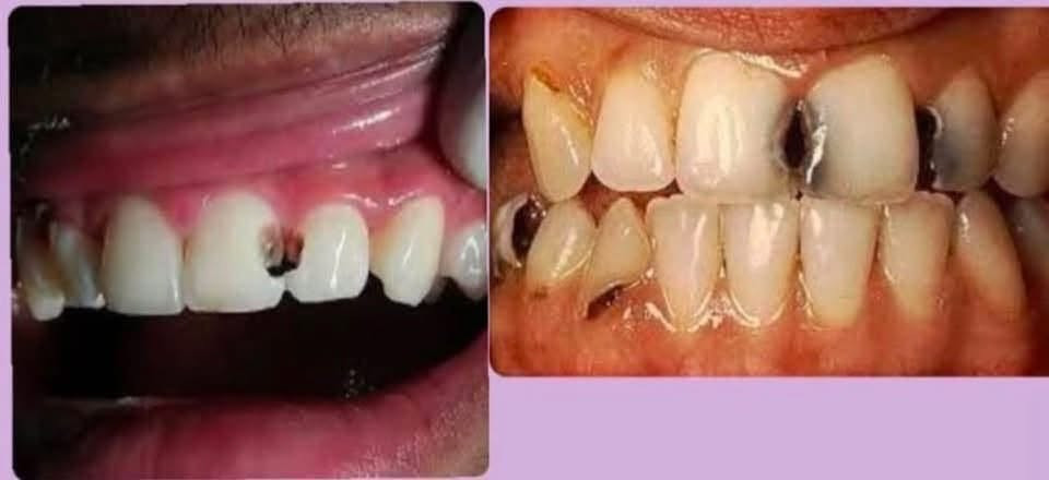 علاج مجاناً لأهالي بغداد
السلام عليكم 
علاج الاسنان في عيادات جامعة الاسراء مجاناً لجميع الحالات التالية
-تنظيف
-قلع بقايا الجذور
-قلع الاسنان
-حشوات ضوئية
-حشوات جذور
-حشوات تجميلية
-تقويم للحالات البسيطة
-طقم اسنان متحرك( تعويض الاسنان )
كل هذا مجاني وبالخدمة
للاستفسار *********** يرجى الإرسال على واتساب او على الفيس بوك

نص مكتوب في الصور:
- قلع بقايا جذور الاسنان