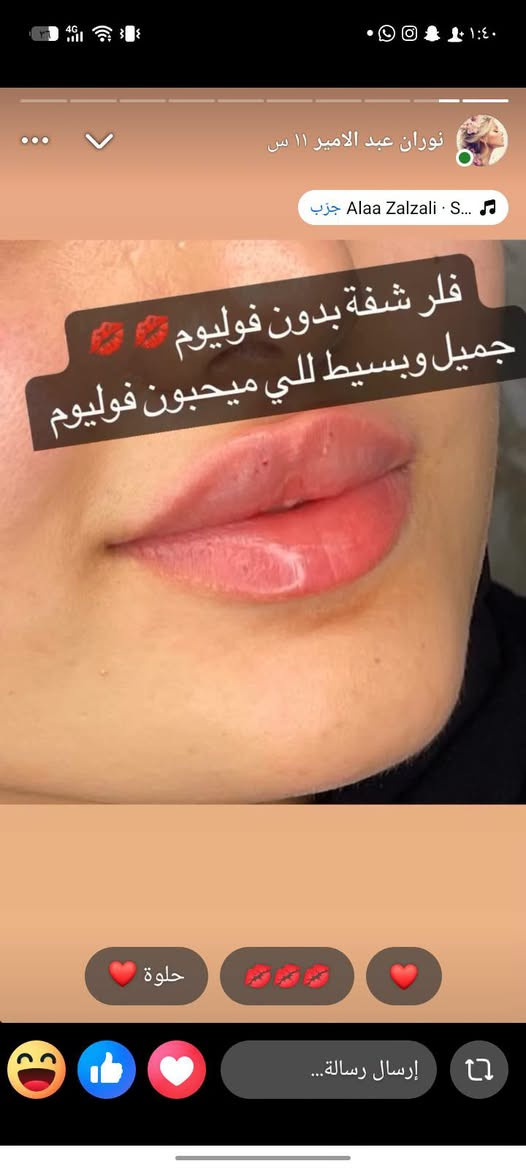 العرؤؤؤض 🔥 ب عياده دكتوره نوران علي للجلديه والتجميل 
شارع النجمه عماره دكتور محمد حمزه طابق ثاني  آخر غرفه رقم الحجز الاتصال او الواتس
***********

نص مكتوب في الصور:
- عرض الفل بدي بجهاز كانديلا الثلجي فقط بـ 55 عند دفع جلستين الجلسة الثالثة مجاناً استغلوا العرض بنات بشرة ناعمة وخالية من الشعر نتائج فعالة من أول جلسة تبريد ثلجي راحة أكثر الحجز دايركت
- نوران عبد الامير ١١ س Alaa Zalzali - S... فلر شفة بدون فوليوم جميل وبسيط للي ميحبون فوليوم حلوة إرسال رسالة...
- إرسال رسالة...