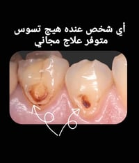 علاج مجاني • قلع أسنان • حشوات جذور