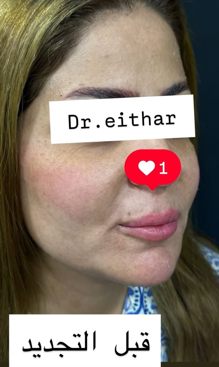 كونتور الوجه  (لفتنك وجنات  واصداغ وتدوير الفك والذقن ونظاره وشفة ونظاره وبوتوكس بعد الحقن باسبوعين ) 🔥🔥🔥

اتمددت عروووض للكادر التدريسي والخريجات والموظفات والعروسات لنهايه الاسبوع ليوم الاربعاء اخر يوم  ثبتتهه الكم بالستوري بالهايلايت وببوست اعلى الصفحة ✨✨

د.ايثار سامي عبد الامير
واسط الكوت الهوره مجمع القبطان طابق اول 

الحجز***********

نص مكتوب في الصور:
- Dr.eithar 1 تجديد لفتنك وجنات واصداغ وتدوير الفك والذقن وشغة ونظاره وبوتوكس
- Dr.eithar
- 1
- تجديد استداره وجه كامله
- وشفه ونظاره وبوتوكس
- Dr.eithar 1 بعد حقن استداره وجه كامله بطريقة كونتور وشد . وشفه ونظاره وبوتوكس بعد االحقن باسبوعين
- Dr.eithar 1 قبل التجديد
- قبل الحقن والصور الي بعد هي بعدالحقن باسبوعين