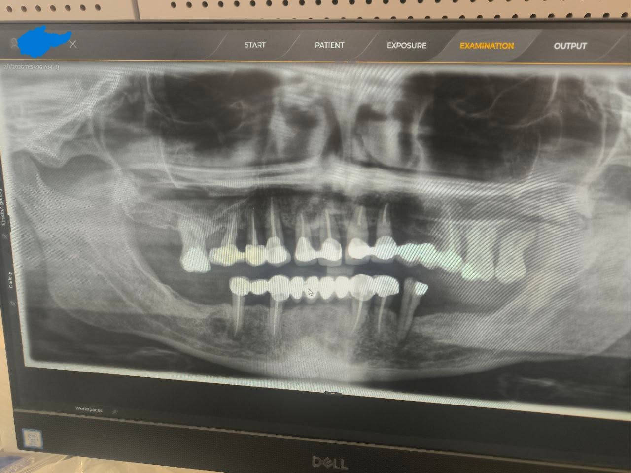 🦷 فرصة علاج الأسنان في عيادات الجامعة الأمريكية في بغداد
العلاج يتم تحت إشراف أطباء اختصاص وضمن نظام تشخيص أكاديمي دقيق.
✔️ حشوات تجميلية
✔️ تنظيف أسنان
✔️ حشوات جذور
✔️اعادة علاج حشوات الجذور الفاشلة سابقا Endodontic Retreatment
✔️زراعة اسنان
✔️عمليات زراعة العظم Bone Augmentation/Graft
✔️ تراكيب سنية
✔️ فحص وتشخيص كامل, جميع انواع الاشعة Intra oral, OPG, CBCT
📍 الموقع: الجامعة الأمريكية في بغداد – شارع المطار
📞 للحجز والاستفسار (واتساب): ***********
او للتسجيل السريع على الرابط التالي:
https://forms.office.com/r/Tfw1V8bL6t?origin=lprLink
⚠️ الإعلان لغرض تنسيق المواعيد ولا يمثل جهة رسمية تابعة للجامعة.
صور الجامعة من auib_shine
