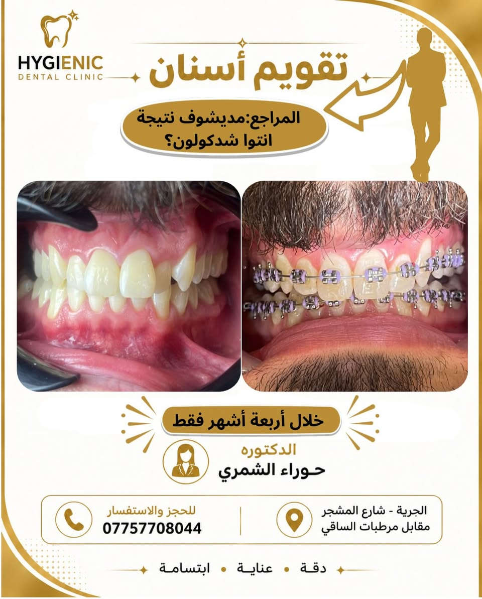 تقويم أسنان • عيادة هايجنك • نتايج ٤ أشهر