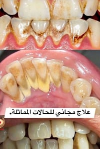 تنظيف سنان • علاج مجاني • السبت