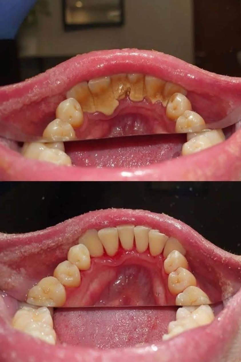 ( مجاني )

ديالى بعقوبة - جامعة اليرموك
الي عنده بقايا اسنان او اسنان تعبانة و تحتاج قلع يراسلني خاص او واتساب *********** نحجز موعد

العلاج مجاني و تحت إشراف اطباء اختصاص

الخدمات الى نقدمها :
_تنضيف اسنان وإزالة التصبغات و التكلسات
_حشوات ضوئية تجميلية وعلاجية
_تعویض اسنان مفقودة اسنان مفردة او كاملة 
_قلع اسنان او بقايا الجذور

نص مكتوب في الصور:
- قبل بعد تعويض الاسنان المفقودة بطقم جزئي او كامل متحرك BEFORE FLEXIBLE NYLON DENTURE AFTER
- تسوسات بين الاسنان الخلفيه او الاماميه