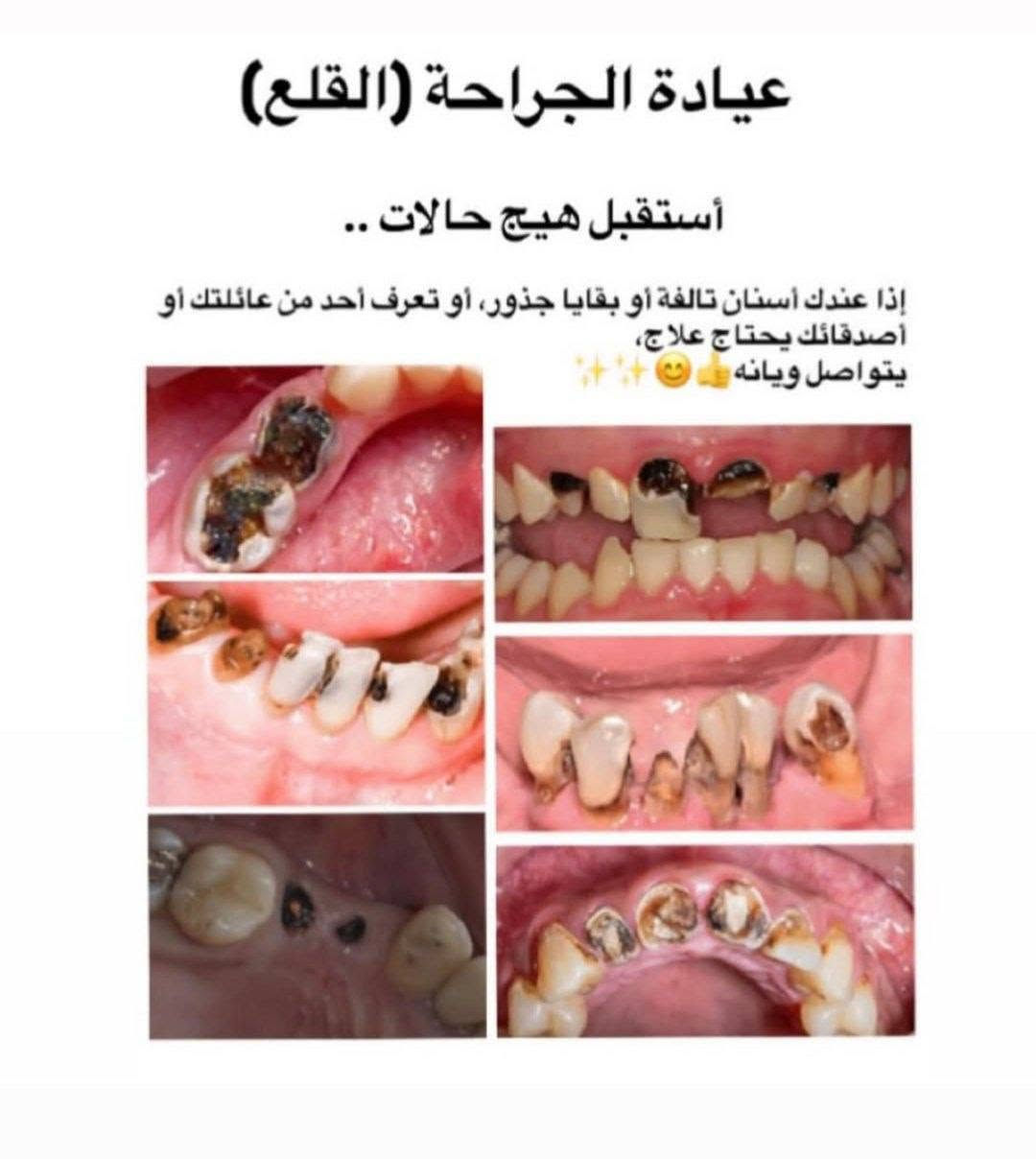 أكو إمكانية للعلاج مجاناً ضمن الحالات المتاحة.
الخدمات المتوفرة: 🦷 حشوات عادية
🦷 قلع الأسنان التالفة والجذور المتبقية
🦷 طقم أسنان جزئي
🦷 تنظيف وإزالة التكلسات
العلاج يتم  في عيادات الجامعةوتحت إشراف الكادر المختص.
📍 بغداد/ شارع فلسطين
📩 إذا حاب/ة تستفسر عن حالتك، راسلنا خاص 🤍
واللي يعرف شخص محتاج، خلي يدزله المنشور 🌷
 للمراسلة واتساب ***********

نص مكتوب في الصور:
- عيادة الحشوات الضوئية (التجميلية )
- أستقبل كل هاي الحالات من التسوس .
- فالي عنده هيج تسوس يتواصل ويانه لأستبدالها بحشوات ضوئية تجميلية ☺️👍
- عيادة الجراحة (القلع) أستقبل هيج حالات .. إذا عندك أسنان تالفة أو بقايا جذور، أو تعرف أحد من عائلتك أو أصدقائك يحتاج علاج، يتواصل ويانه ✨😊✨
- عيادة صناعة الأسنان (تركيب طقم جزئي متحرك) أستقبل هيك حالات.
- عيادة تنظيف الأسنان و أزالة التكلسات أستقبل هيج حالات. حته نحافظ ع نظافة وصحه أسنانكم