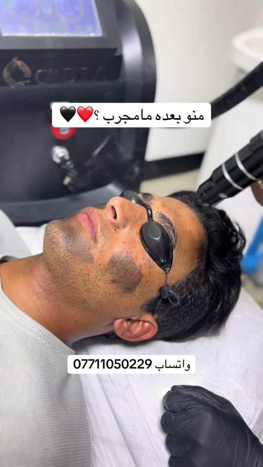 تقشير كاربوني لعلاج البشره الدهنيه والتصبغات سعر الجلسه ٢٠ الف فقط العنوان بغداد الغدير ساحة ميسلون فلكة الغدير  للتواصل *********** الانستا موجود بالبايو حياكم الله بكل الايام من 12 الضهر الى 12 ليلاً #مرتضى_سنتر #تنظيف_البشرة #حلاقة #تقشير_البشرة 
