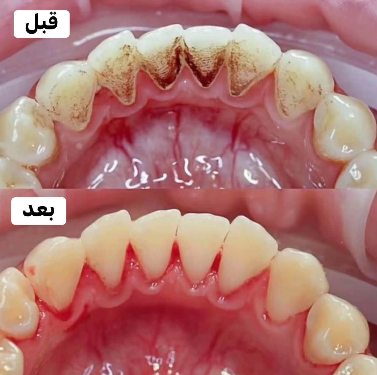 مجاني • عيادات جامعة الفارابي • حشوات/تبيض/قلع
