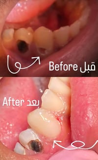 حشوه • تنضيف اسنان • مجاني