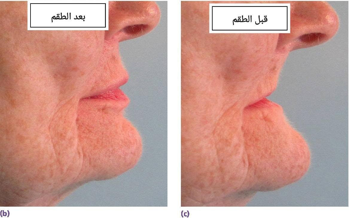طقم أسنان • حجز موعد • جامعة الموصل