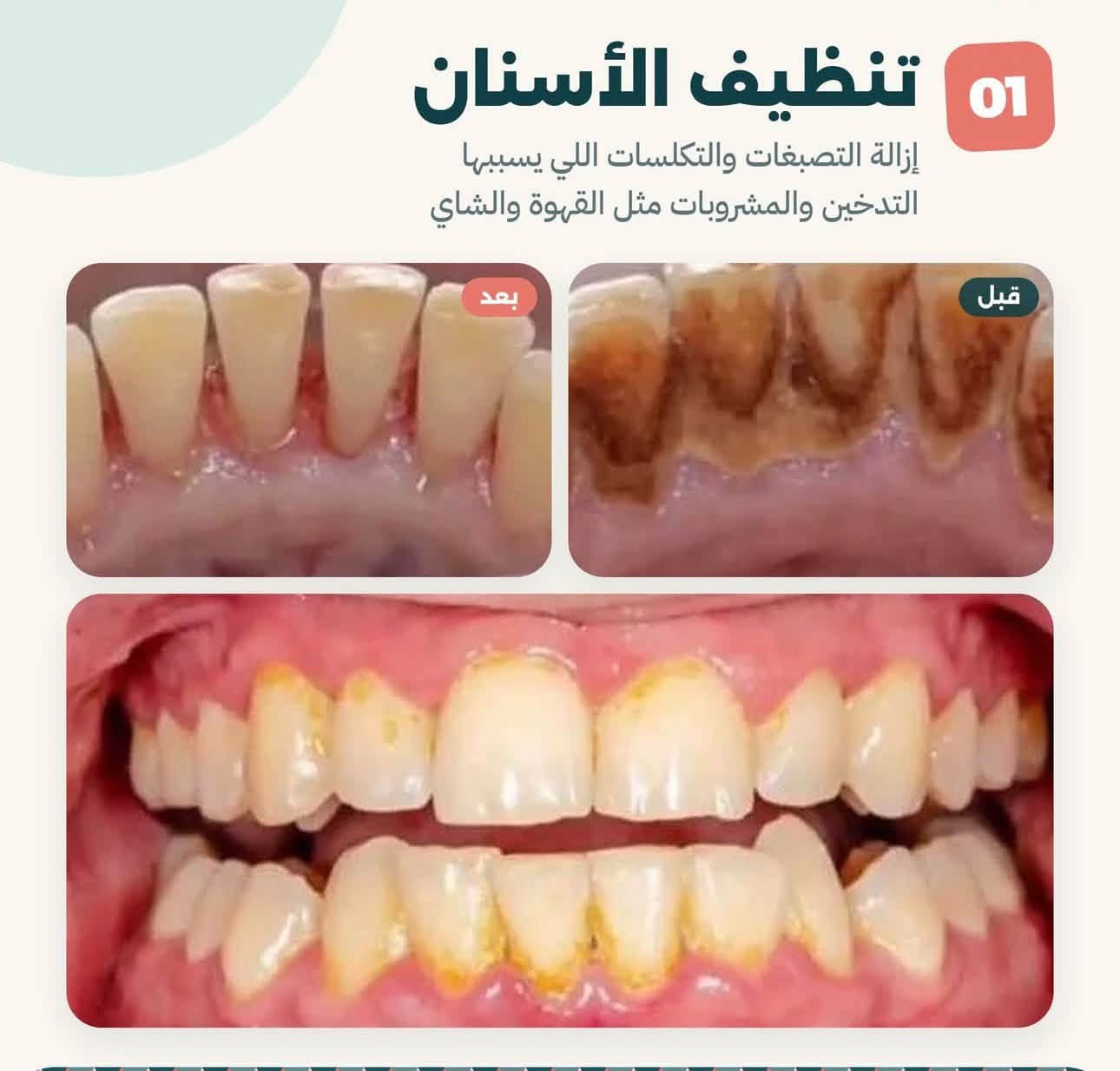 الكرادة جامعة اوروك • علاج مجاني • تنظيف الأسنان