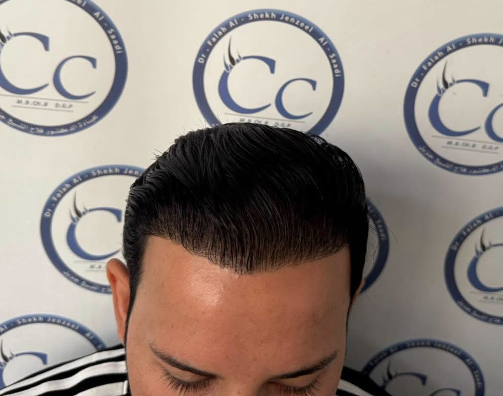 زراعة شعر • نتائج بعد سنتين • فلاح الساعدي