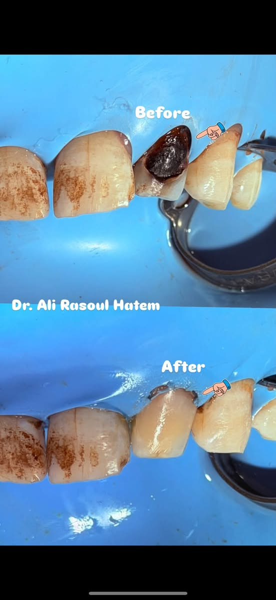 .  نسعى دائماً لتخفيف الالم 
ومساعدتكم في صنع الابتسامه 
 ب اجواد المواد وافضل الطرق التكنيكية 
يكون العمل مجاني 💵
وتحت اشراف اطباء مختصين 👨‍⚕️
للتواصل دايركت. ‪‪@al9ra‬‬ 
واتساب ***********
سنكون بنتظاركم ونعمل معاً لصنع ابتسامة تليق بكم 
زوروا موقعنا. 📍 شارع 40 قرب صيدلية سلامتك ( #عيادات_طب_الأسنان_جامعة_الحله)

سلامة اسنانك جمالك للمستقبل 🤍🦷
.
