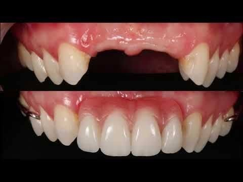 طقم اسنان متحرك • مجانا • قبل وبعد