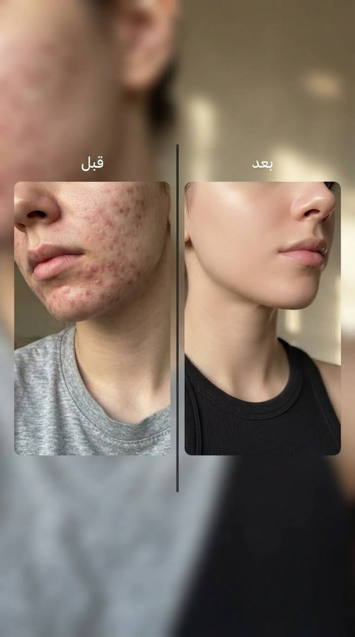 لا مستحيل ‼️‼️
هيج قوي ؟؟ اي والله

نص مكتوب في الصور:
- أقوى معالج للحبوب ، يرطب ويصفي البشرة 🔥🍯 توفر يمنا هذا المعالج الترند 👑 مكوناته عكبر النحل والو فيرا يعني فوكوها طبيعي يخبللل 🍃😍 للطلب خاص حبيباتي للطلب خاص حبيباتي
- قبل
- بعد